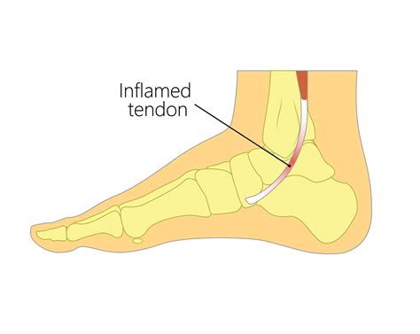 Posterior Tibial Tendonitis – Foot Scientific Store