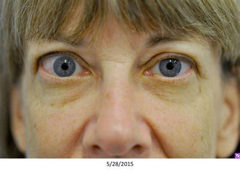 Thyroid eye disease treatment |OHSU News