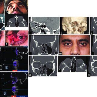 (a) A and B: clinical picture showing enophthalmos right eye and loss ...