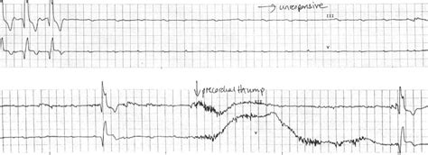 ECG Motion Artefacts • LITFL • ECG Library Diagnosis