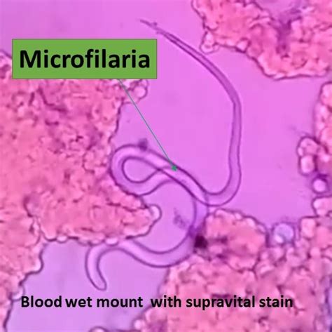 Microfilaria in Blood Wet Mount: Introduction and Blood Wet Mount Prepar