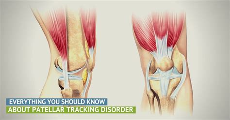 The TRUTH About Patellar Tracking Disorder | Precision Movement