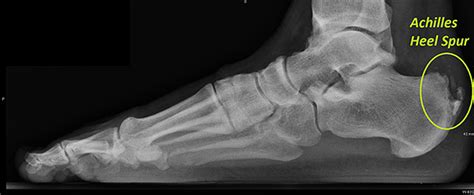 Achilles Tendon Surgery | Dr. Alice Wang