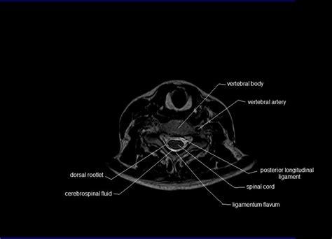 MRI spine anatomy | free MRI axial cervical spine anatomy | Mri ...