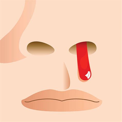 nosebleed clipart 20 free Cliparts | Download images on Clipground 2024