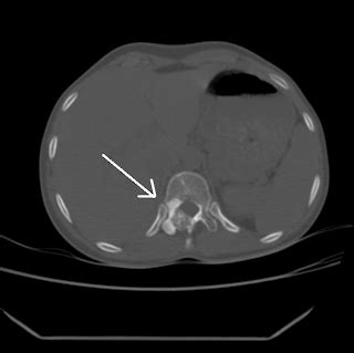 Osteoid Osteoma Dorsal Spine-CT - Sumer's Radiology Blog