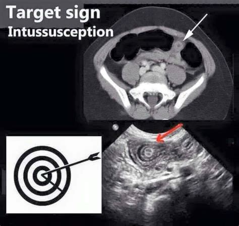 Target sign | Radiology, Medical mnemonics, Radiology student