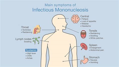 All you need to know about mononucleosis in children – Healthy Food Near Me