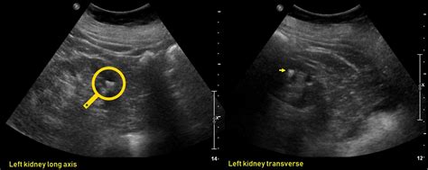 Ultrasound features of Kidney Cysts - Renal Fellow Network