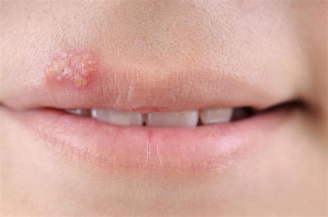 What are Different Types of Mouth Sores? (with pictures)