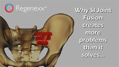 Si Joint Fusion Success Rate | Science Relief