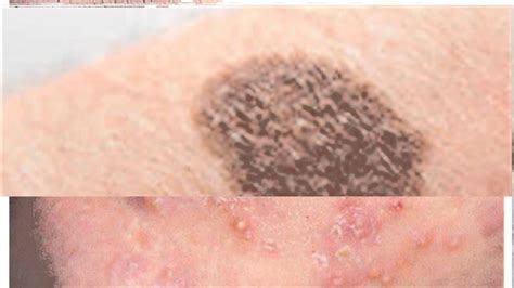 10 Most Common Skin Disorders