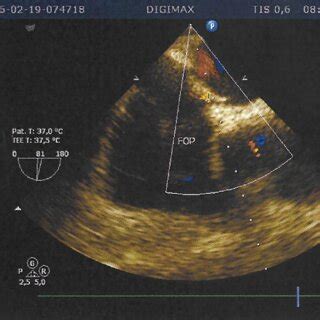 Transesophageal bubble study echocardiogram showing a patent foramen ...