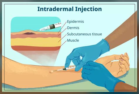 Xylocainempfepinephrine Injection Uses Side Effects