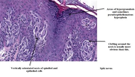 Dermpath Made Simple - Neoplastic: Spitz Nevus and Reed Nevus