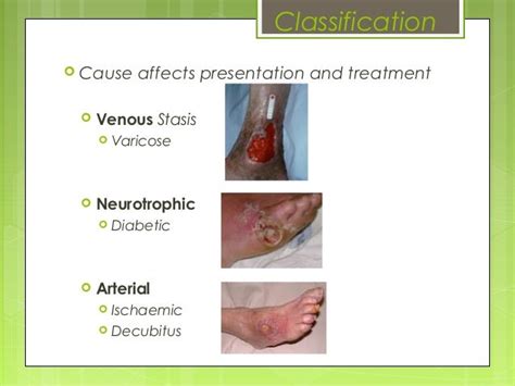 Venous Stasis Ulcer Stages