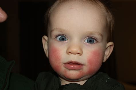 Fifth's disease | Rash on face, Fifth disease, Medical