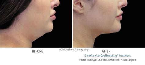 CoolSculpting Chin and Neck Fat | Eliminate Double Chins and Turkey Necks