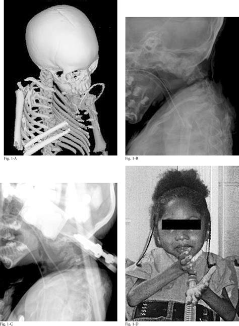 Figure 1 from Chin-on-chest deformity in patients with fibrodysplasia ossificans progressiva. A ...