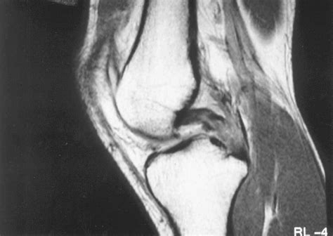 PCL Injury - Knee & Sports - Orthobullets