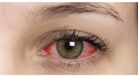 Uveitis Eye Inflammation Causes, Symptoms, Complications,, 40% OFF