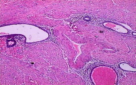 Adenomyoma