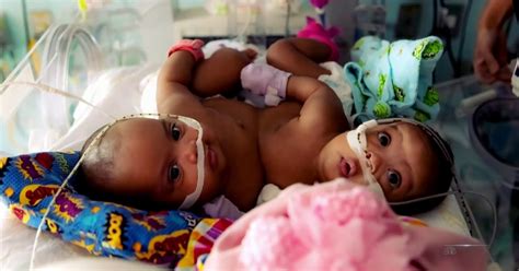 Conjoined twins separated in miracle procedure