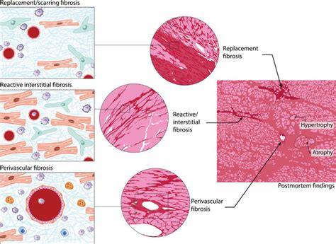 Myocardial fibrosis can be present as replacement/scarring, reactive... | Download Scientific ...