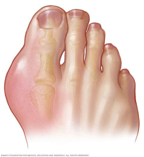 Gout - Mayo Clinic