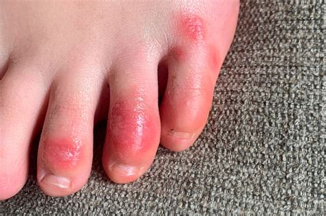 'COVID toes,' other rashes latest possible rare virus signs - WHYY