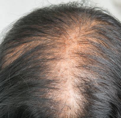 Telogen Effluvium - Hair Loss Causes, Symptoms | Hair Restoration