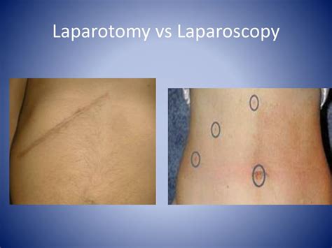 Laparotomy Meaning