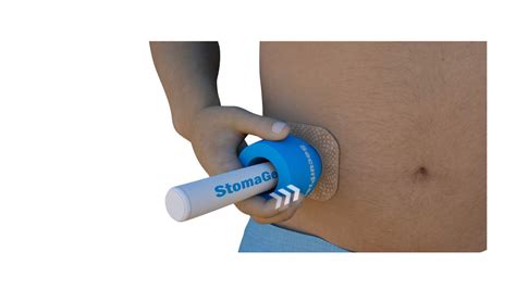 Buy SECURPRESS Stoma Secure Device - 1-Pack - (1 1/4"), for Any Type of Ileostomy, Urostomy ...