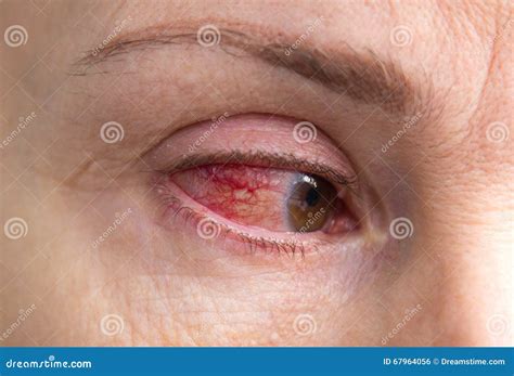 Severe Eye Injury with Blood Stock Photo - Image of human, lens: 67964056