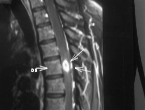 T1 contrast sagittal image showing the ring-enhancing lesion at D5 level | Download Scientific ...