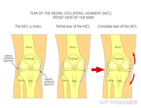 #膝盖疼# 内侧副韧带伤了该如何康复？ - 知乎