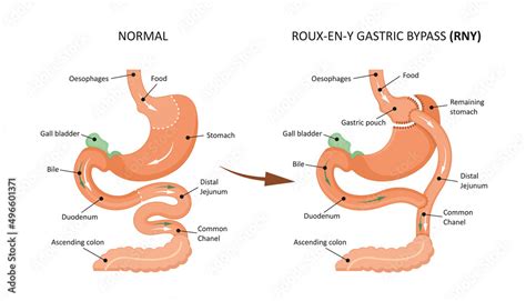 Roux-en-y gastric bypass (RNY). Showing a gastric pouch and ...