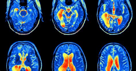 MRI scan image of brain | Regional Medical Imaging