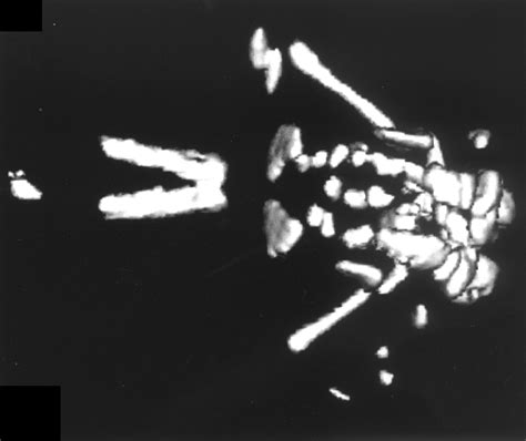 Fetus in Fetu: Three-Dimensional Imaging Using Multidetector CT | AJR