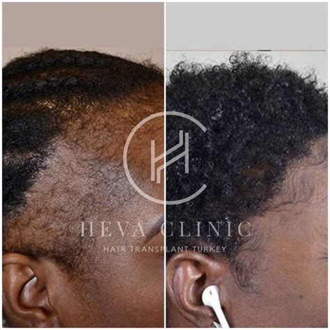 Do Relaxers Cause Hair Loss? - Reasons and Solutions