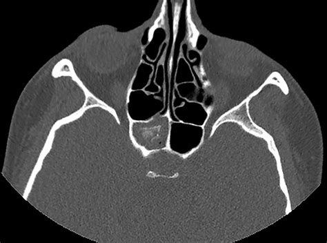 A Rare Cause of Headache in a Patient with Rheumatoid Arthritis: Sphenoid Sinus Fungus Ball ...