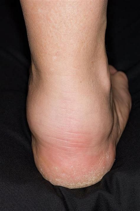 Swollen Ankle From Vasculitis Photograph by Dr P. Marazzi/science Photo ...