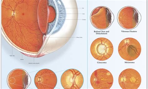 Disorders of the Eye {Infographic} - Best Infographics