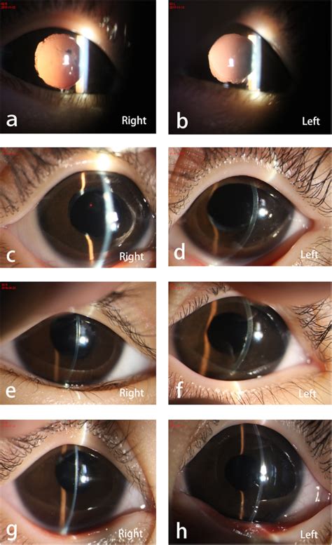 Keratolenticular adhesion removal for type 2 Peters anomaly: a case report | Eye and Vision ...