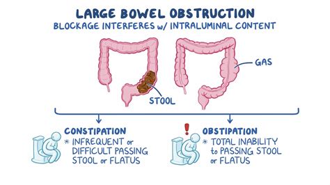 Large bowel obstruction: Clinical sciences - Osmosis Video Library