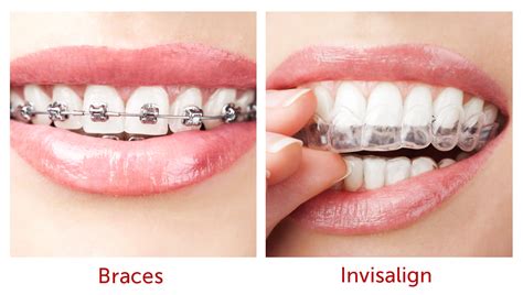 North Sydney Orthodontics Invisalign - North Sydney Orthodontics