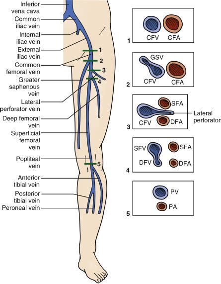 Lower Extremity Deep Venous Thrombosis | Radiology Key