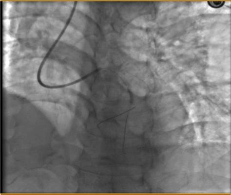 Coronary angiography results | Download Scientific Diagram