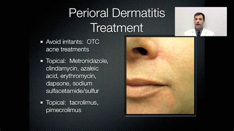 Perioral Dermatitis Treatment - OnlineDermClinic - YouTube