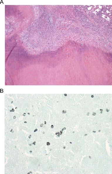 Thoracoscopic lung biopsy of the left upper lobe nodule demonstrates a... | Download Scientific ...